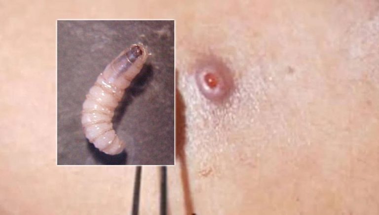 Miasis en humanos por gusano barrenador: 41 casos revelan una plaga en México