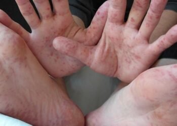 ENFERMEDAD DE MANOS, PIES Y BOCA: Confirman 36 casos en menores de Tulum