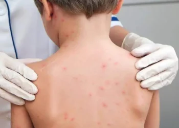 Aumenta alarma por brote de sarampión en jornaleros agrícolas de Durango