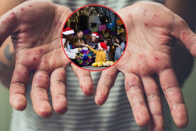 Chiapas bajo alerta sanitaria por brote de sarampión: el virus de origen canadiense