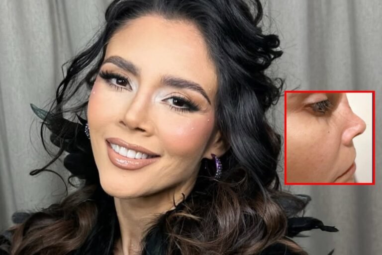 Dorismar, cirugía estética fallida Dorismar, José Achar, rinoplastia fallida, Salvador Padilla