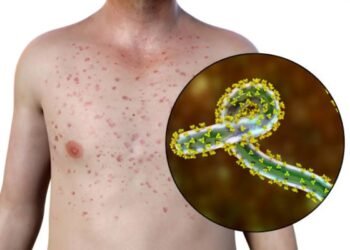 La expansión silenciosa: El virus Marburg escala las muertes en Etiopía