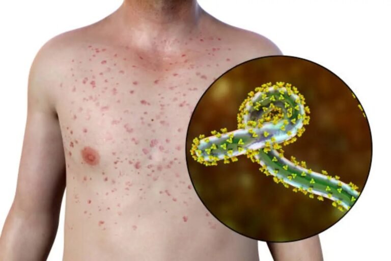 La expansión silenciosa: El virus Marburg escala las muertes en Etiopía