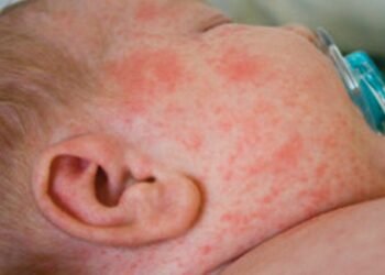 SARAMPIÓN: Advierten alto riesgo en la Península de Yucatán y posible pérdida de certificación sanitaria