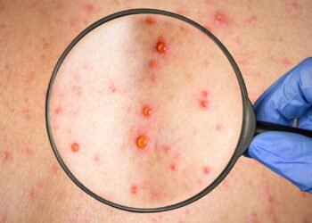 Sarampión en México 2026: Brote, síntomas y riesgo de complicaciones