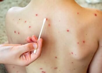 Reportan dos hospitalizados por posible sarampión en Playa del Carmen