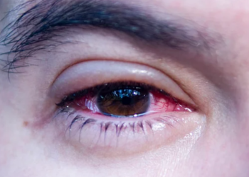 CANCÚN: Reportan primeros casos de conjuntivitis