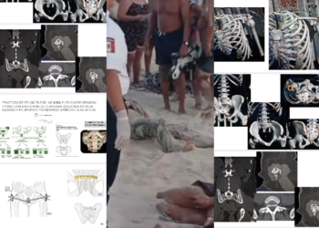 SE AGRAVA VÍCTIMA: Bañista atropellada por moto acuática en Cancún podría quedar parapléjica