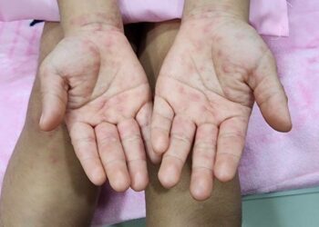 COZUMEL: Atienden caso de virus de coxsackie en un kínder